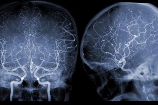 Cerebral angiography image from Fluoroscopy in intervention radiology showing cerebral artery.