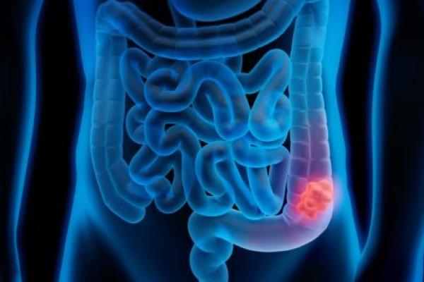 An illustration shows a torso with intestines. A tumor is highlighted.