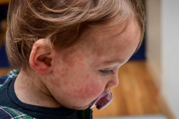 A toddler boy with a red measles rash on his face.