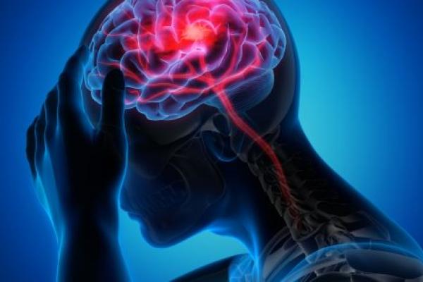 Medical illustration of a brain with stroke symptoms.