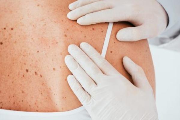 A dermatologist in latex gloves examines a woman for skin cancer.