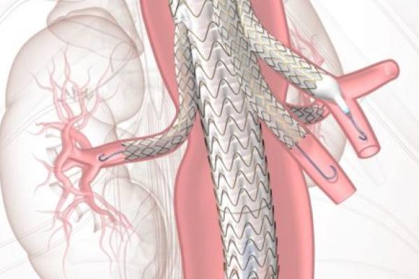 A graphic rendering of a TAMBE device – a stent graft with branches – in place within a patient’s blood vessels.